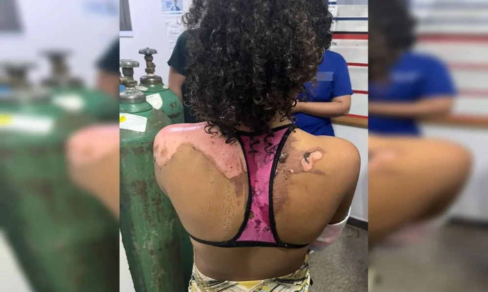 Tia suspeita de queimar sobrinha com água quente é presa em Samambaia