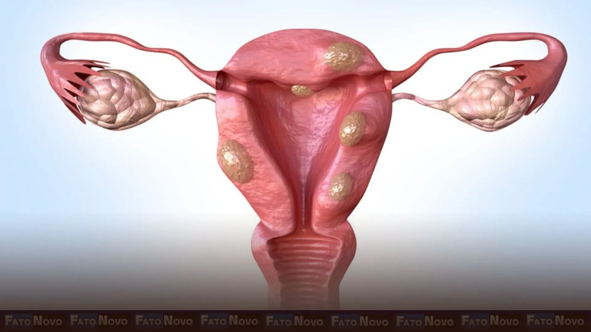 Endometriose e mioma aumentam risco de morte precoce a longo prazo