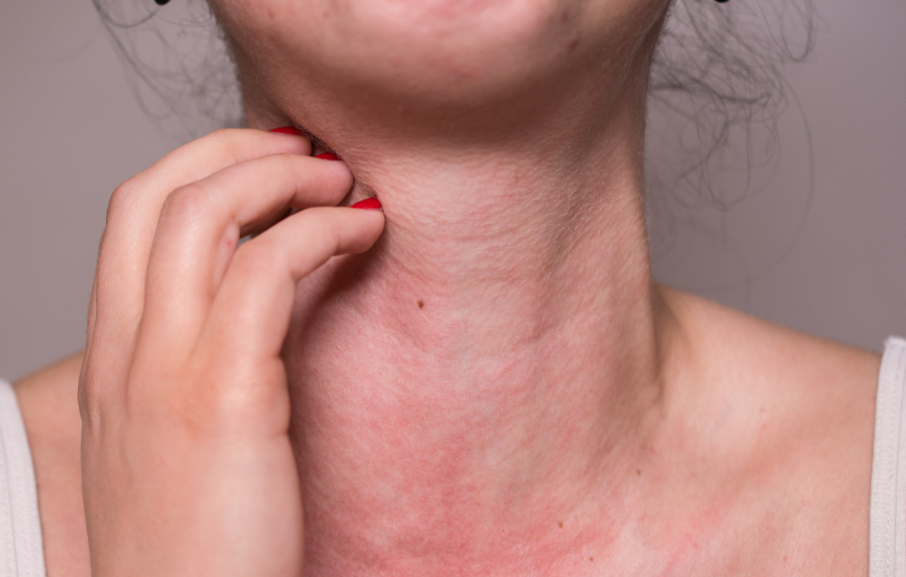 Alergia: quando o medicamento vira risco