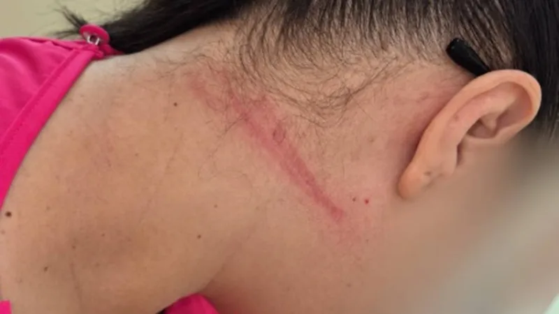 Técnica de enfermagem enforcada com cabo de celular em UPA tem hematomas; Coren-DF cobra botão do pânico