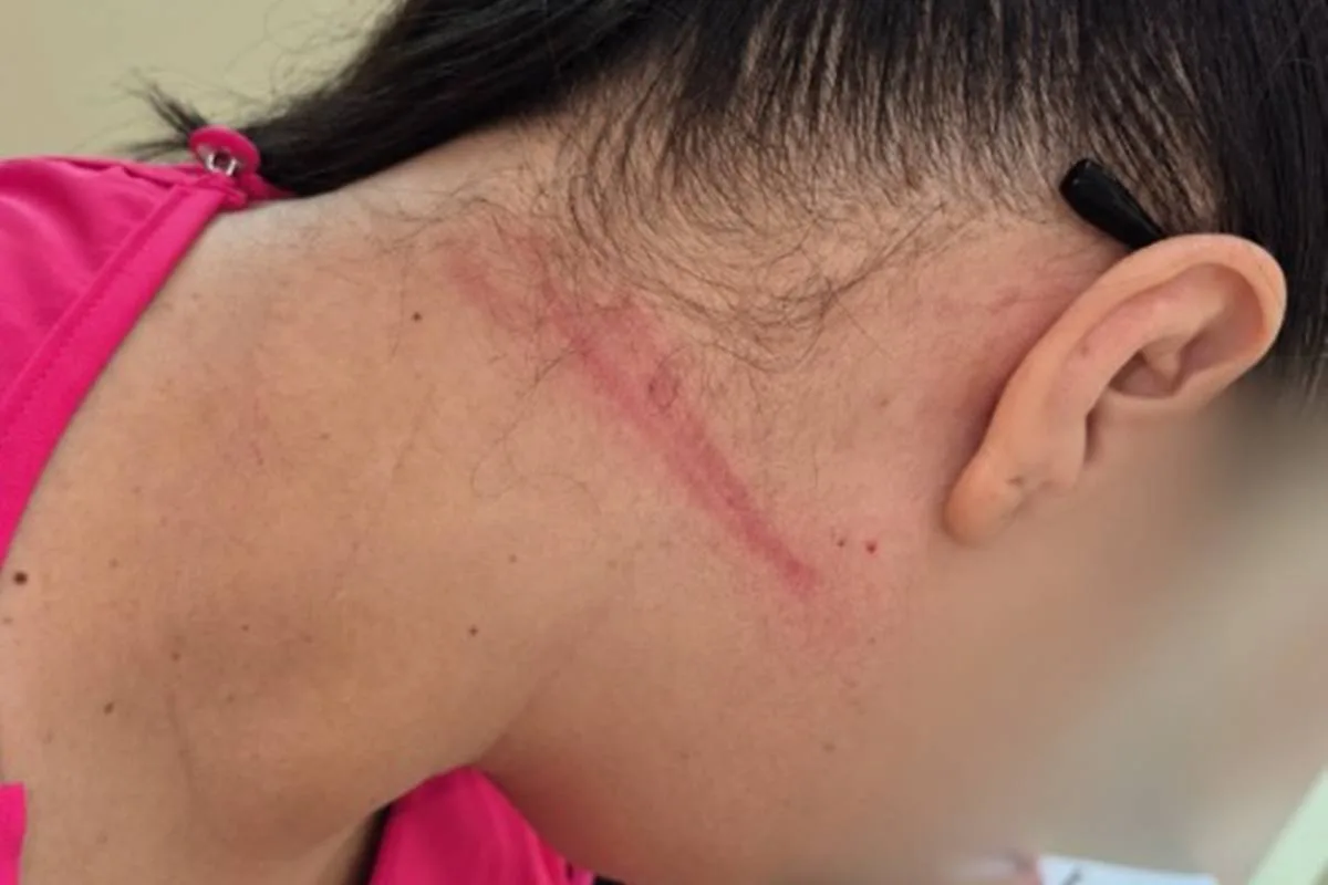 Técnica de enfermagem enforcada com cabo de celular em UPA tem hematomas; Coren-DF cobra botão do pânico